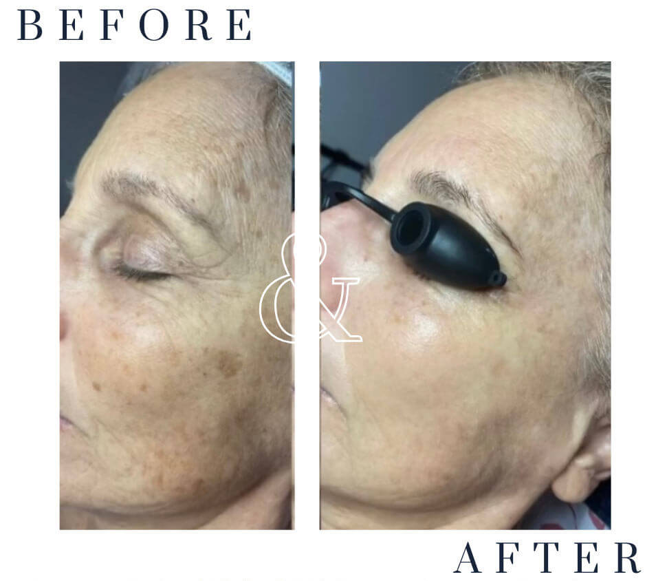 Before and after results showing reduced sun spots and discoloration after IPL in Hot Springs on a mature woman's face.