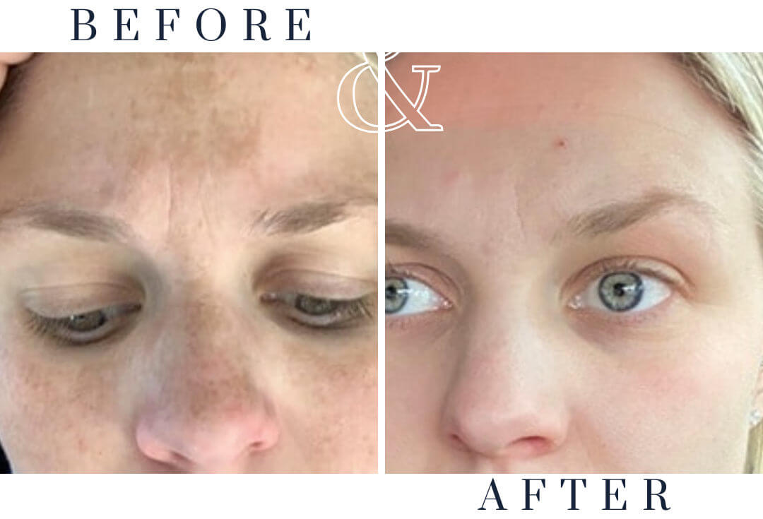 Before and after photo showing clearer, brighter skin after IPL in Hot Springs to treat freckles and uneven skin tone.