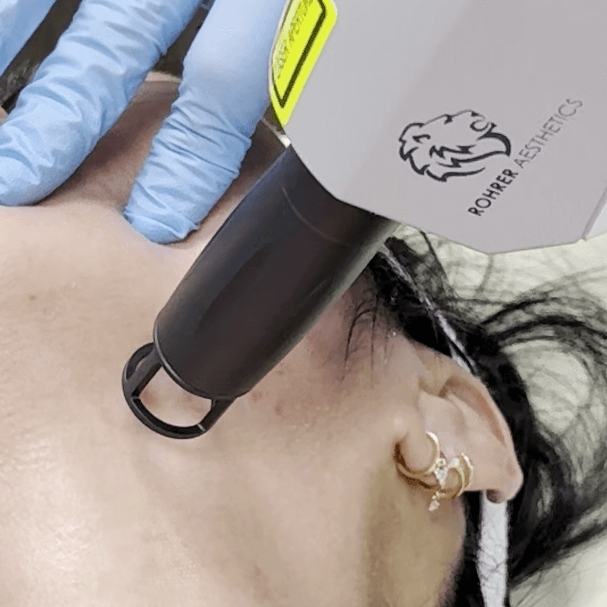 Erbium YAG laser handpiece treating the lower face during a skin resurfacing session at Embrace Eternal Beauty.
