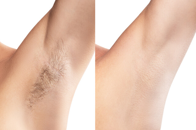 Side-by-side comparison of a female underarm before and after laser hair removal, showing smooth, hair-free results from Embrace in Hot Springs AR.