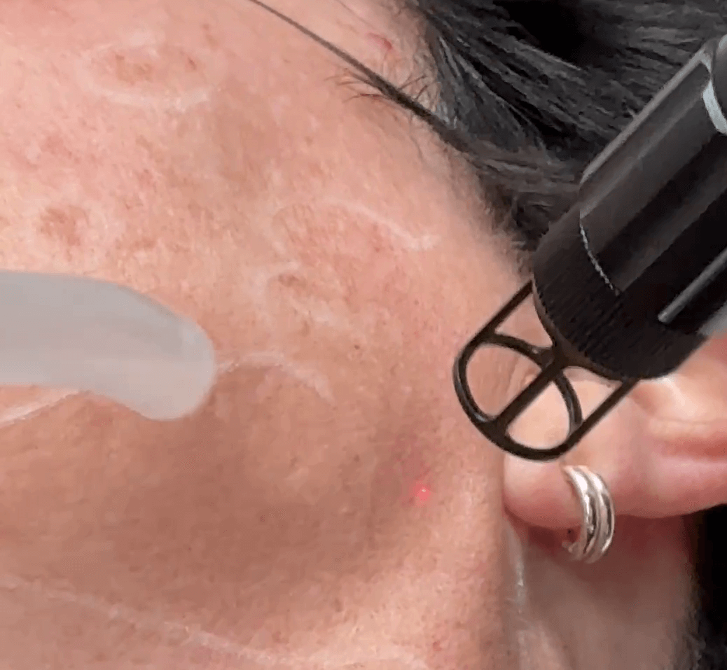 Melasma and dark spots treatment on cheek with laser at Embrace Eternal Beauty in Hot Springs.