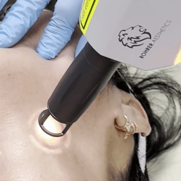 Light energy pulse from Erbium YAG laser during skin resurfacing at Embrace Eternal Beauty in Hot Springs.