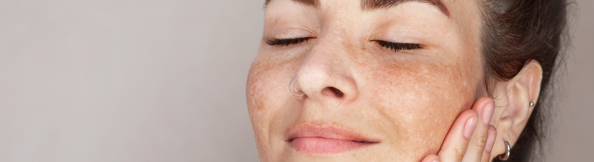 Close-up of woman’s face showing melasma and sunspots before laser pigmentation treatment.