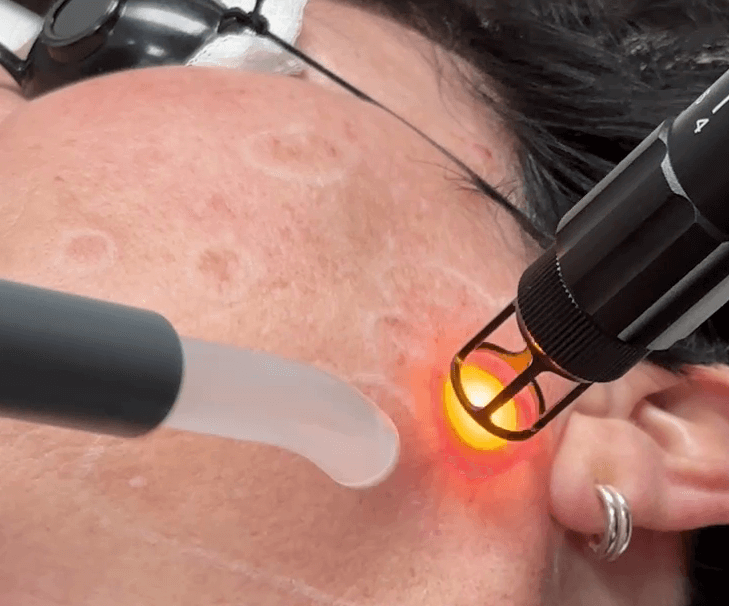 Laser pulse treating facial pigmentation during Q-switched session at Embrace Eternal Beauty in Hot Springs.