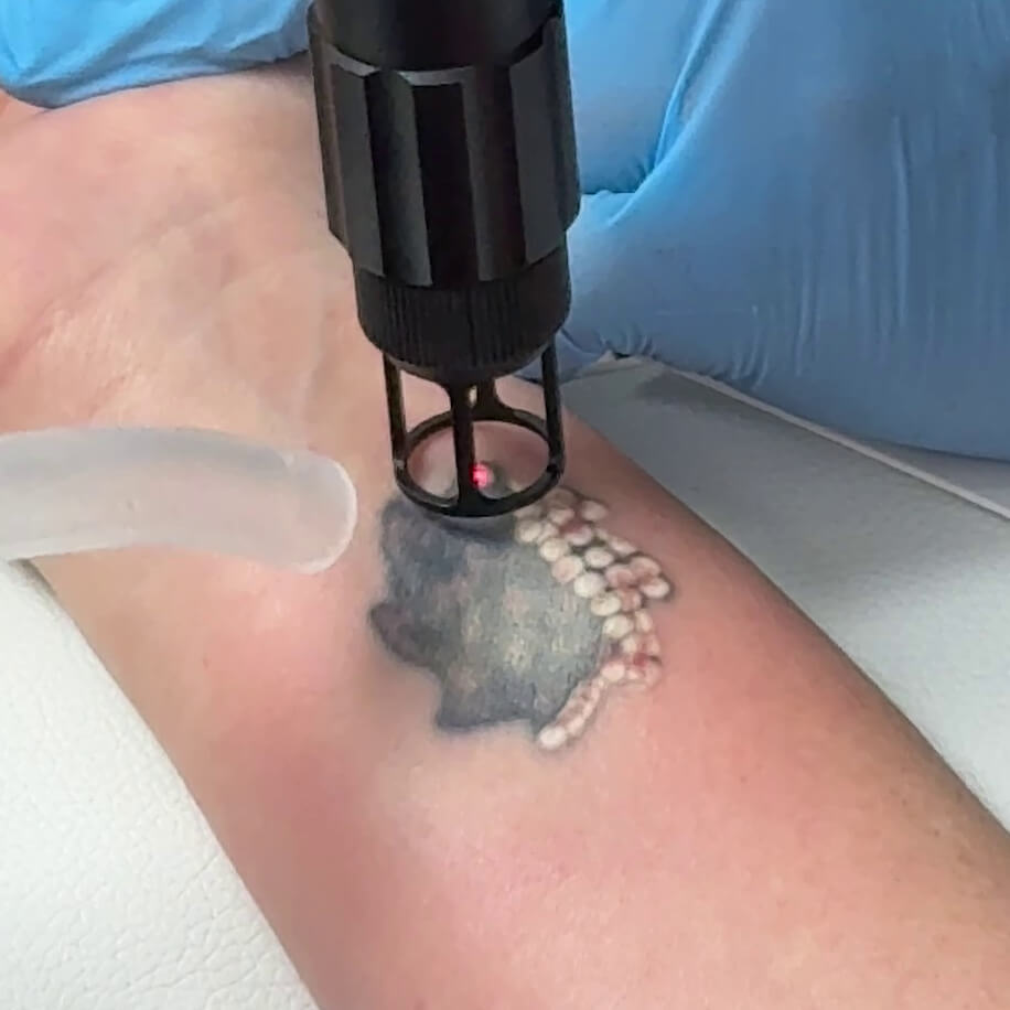 Q-switched laser tattoo removal in progress on forearm at Embrace Eternal Beauty in Hot Springs
