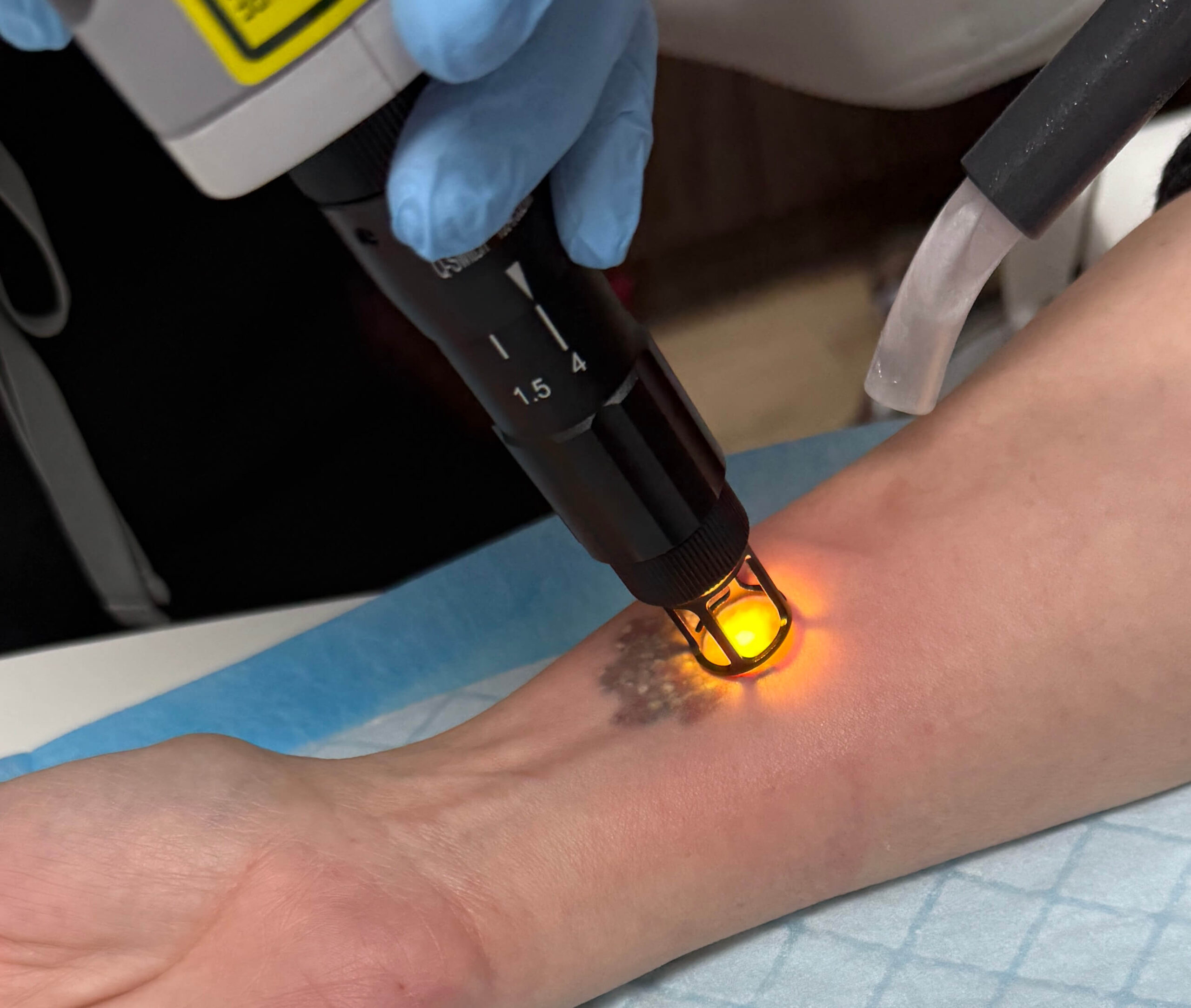 Q-switched laser tattoo removal on forearm at Embrace Eternal Beauty in Hot Springs