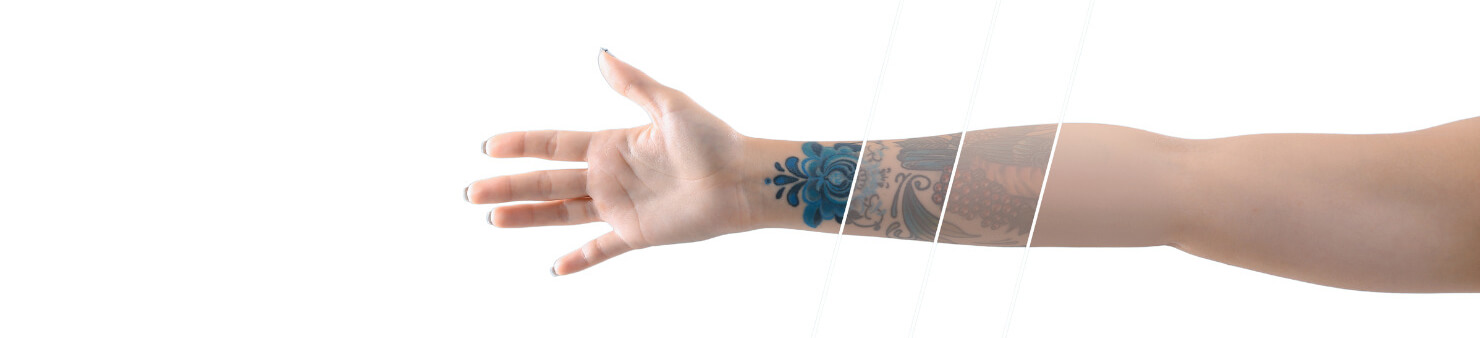 Tattoo fading progression on forearm during Q-switched laser tattoo removal at Embrace Eternal Beauty in Hot Springs.