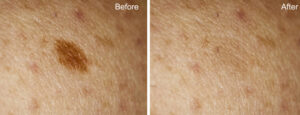 Before and after of dark spot removal with laser pigmentation treatment.