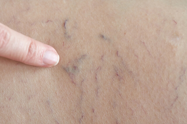 Close-up of spider veins on skin with finger pointing before cosmetic laser vein reduction at Embrace Eternal Beauty in Hot Springs.